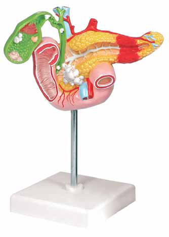 Pathological Model of the Pancreas, Duodenum and Gallbladder